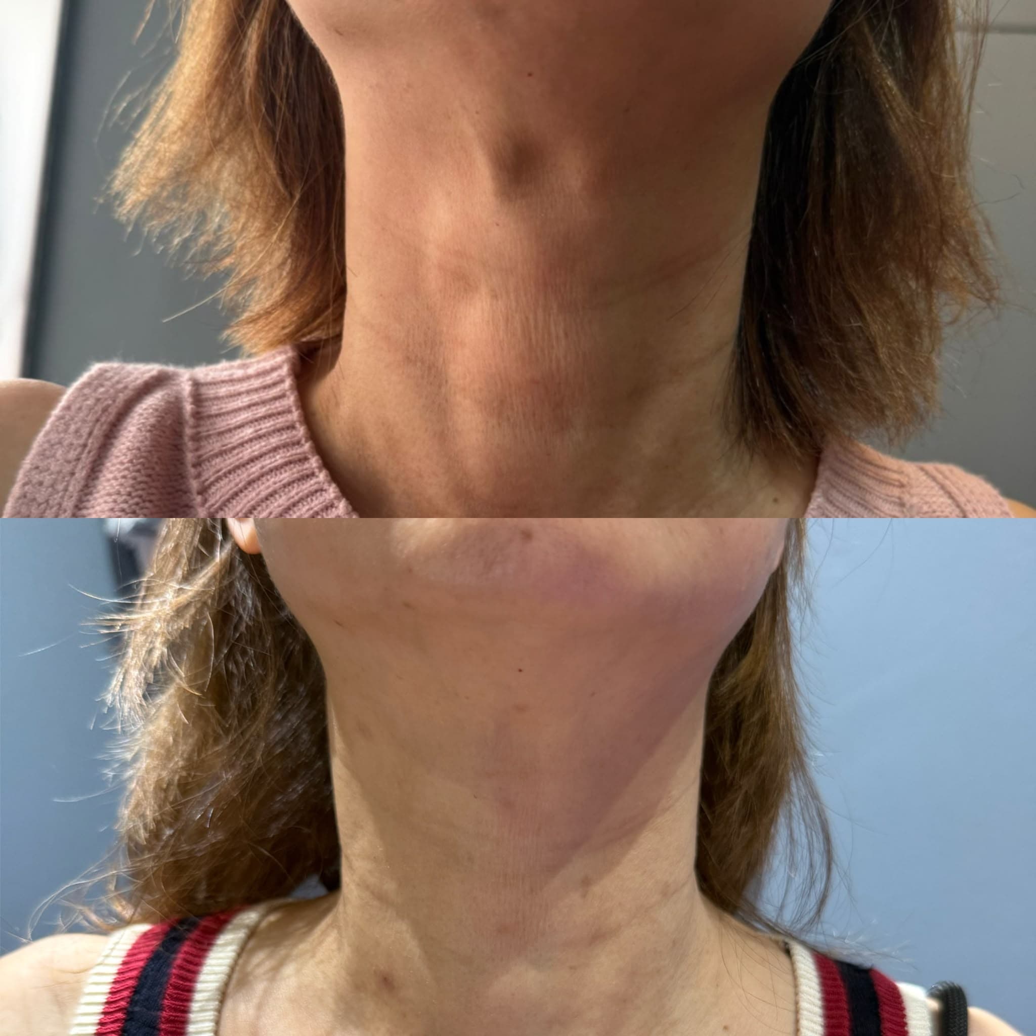 Front neck skin texture before and after a V-Jet Cell Renewal series