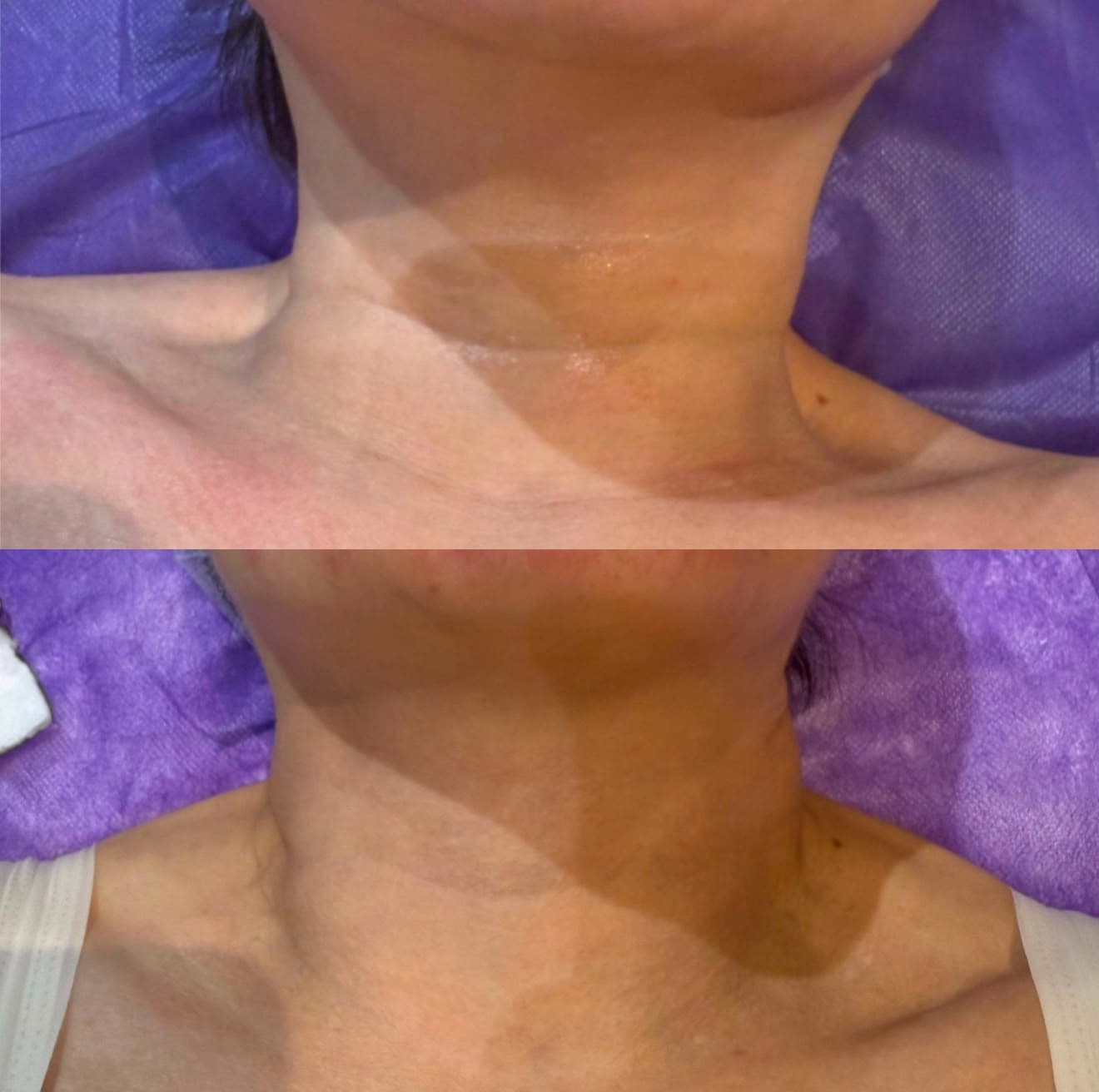 Horizontal neck lines before and after a V-Jet Cell Renewal series