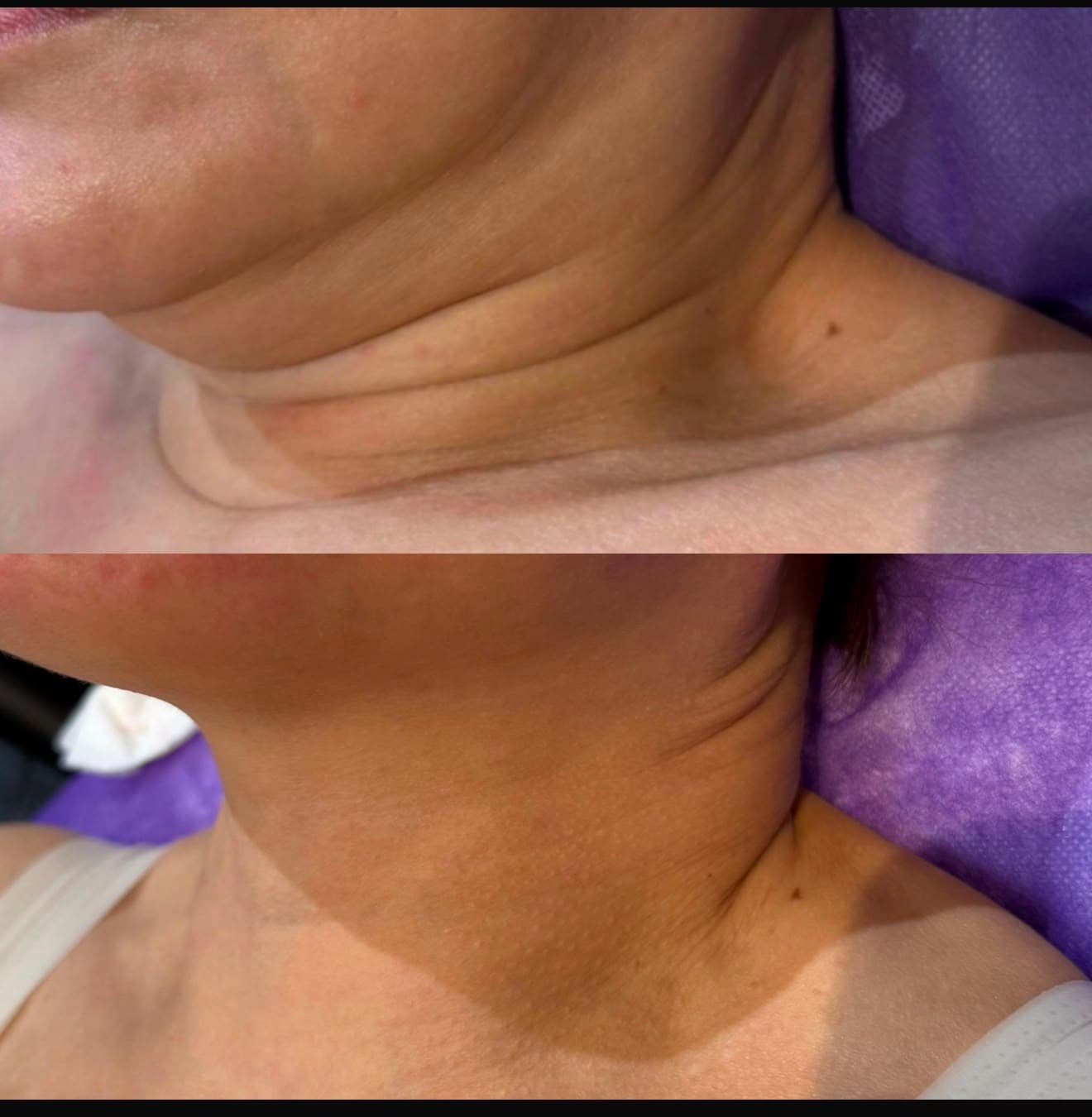 Neck lines before and after a V-Jet Cell Renewal series