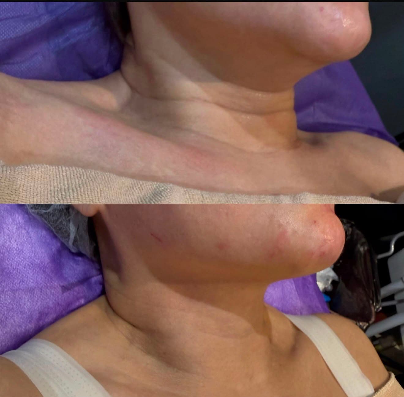 Neck and jawline before and after a V-Jet Cell Renewal series