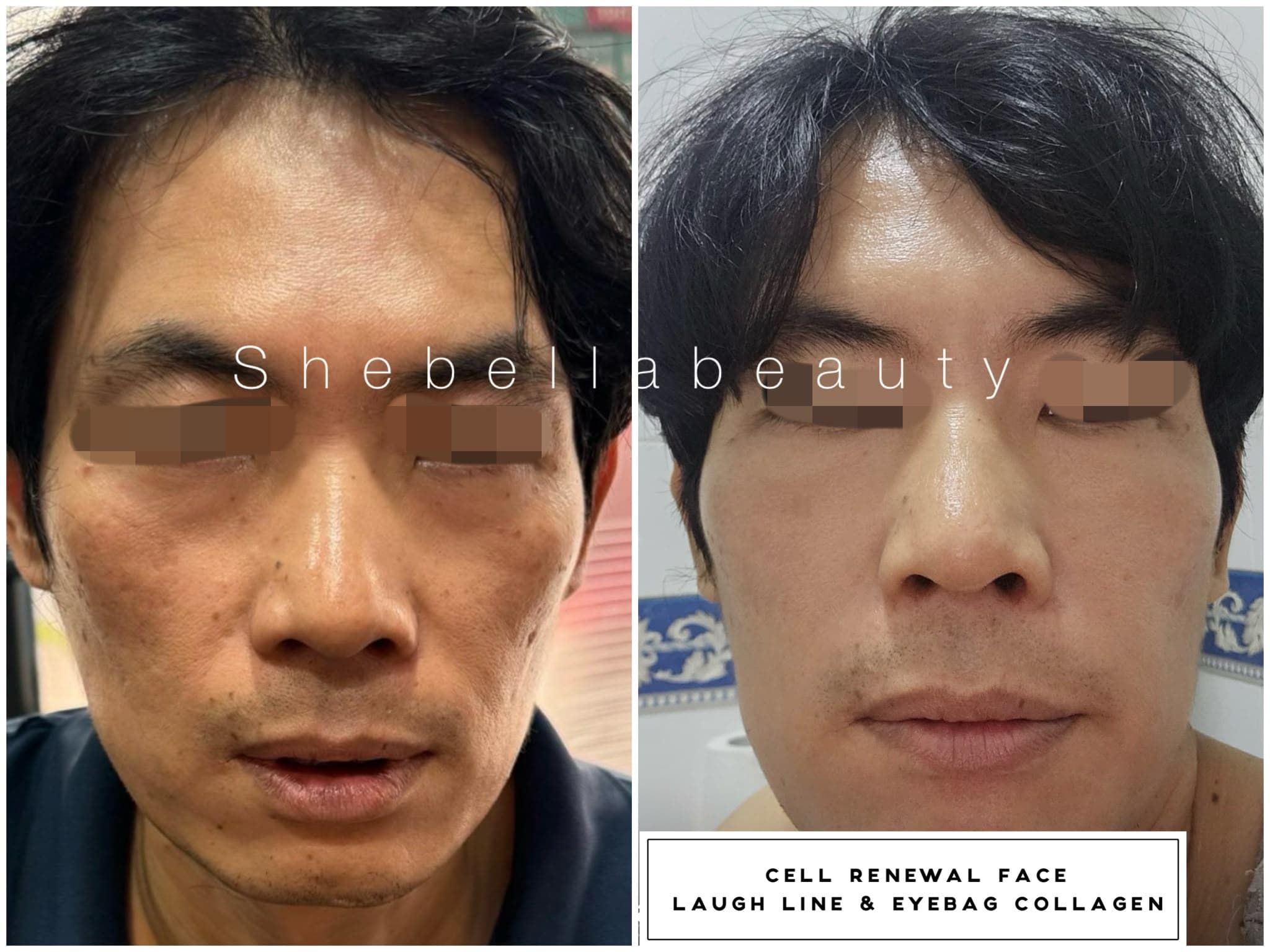 Laugh line and under-eye area before and after V-Jet Cell Renewal collagen support