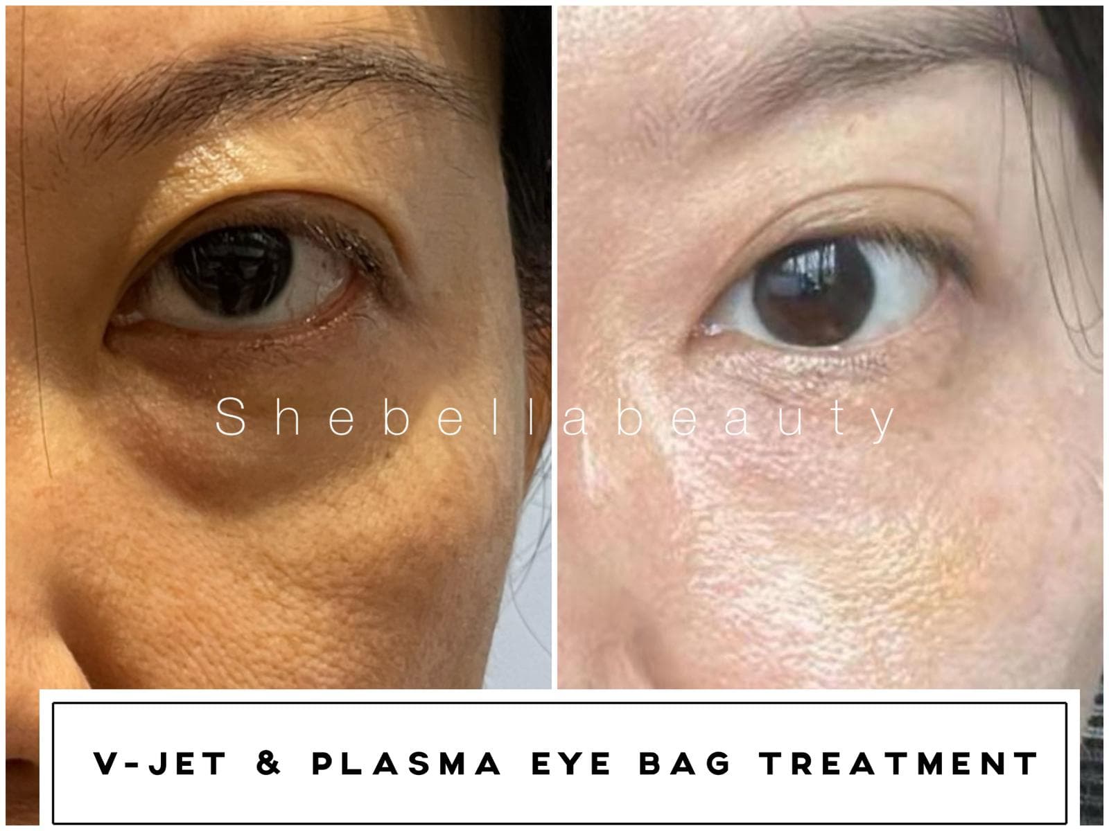 Under-eye bags before and after V-Jet and plasma eye bag treatment