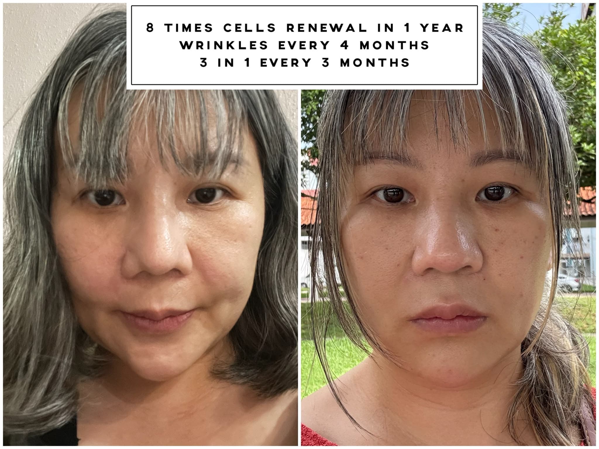 Face before and after eight V-Jet Cell Renewal sessions over one year